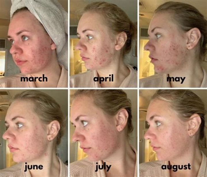Can aczone cause a rash?