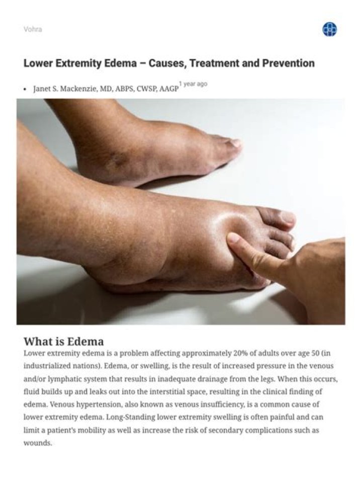 Can cancer cause lower extremity edema?