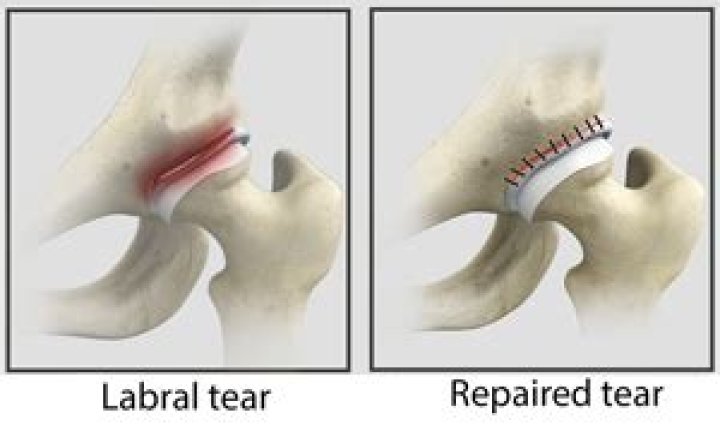 Can hip cartilage be repaired?