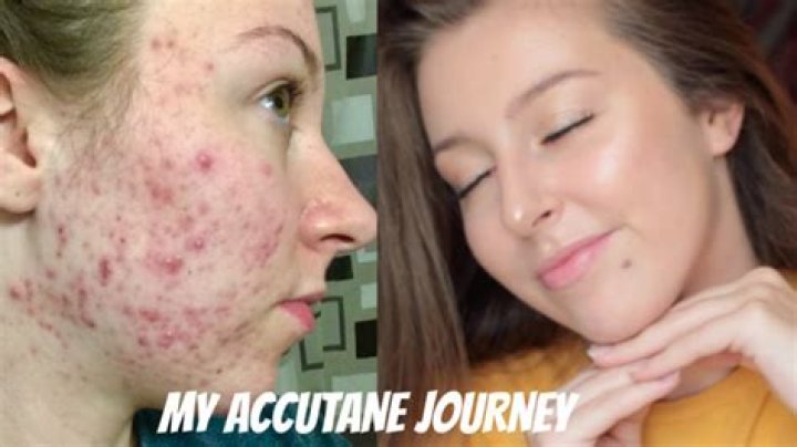 Can isotretinoin remove dark spots?