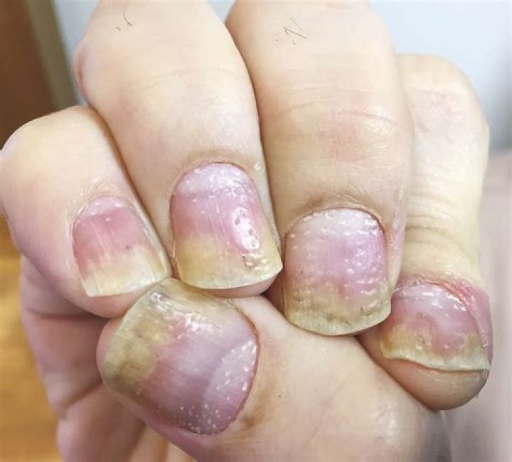 Can pitted nails be cured?