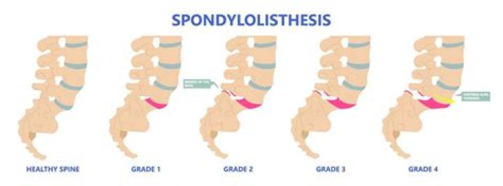 Can retrolisthesis be corrected?