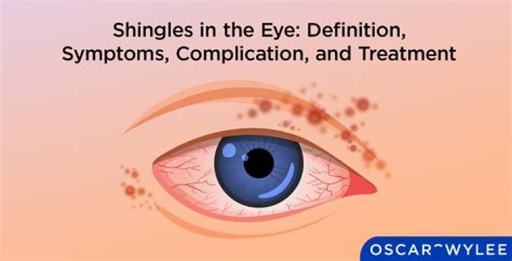 Can shingles affect eyesight?