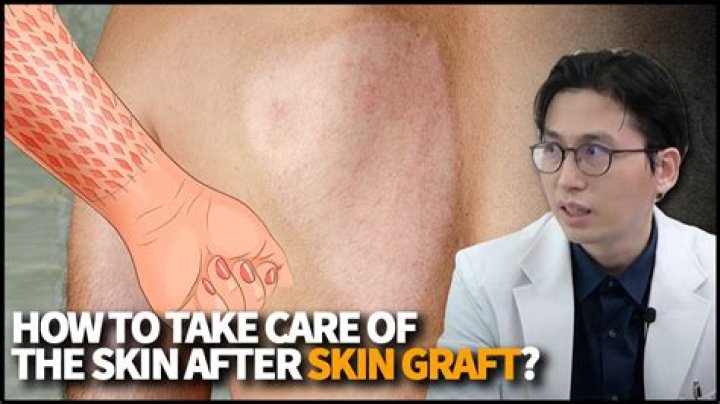 Can skin grafts fail?