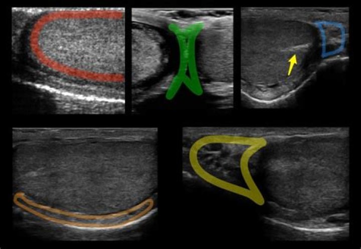 Can you see epididymis on an ultrasound?