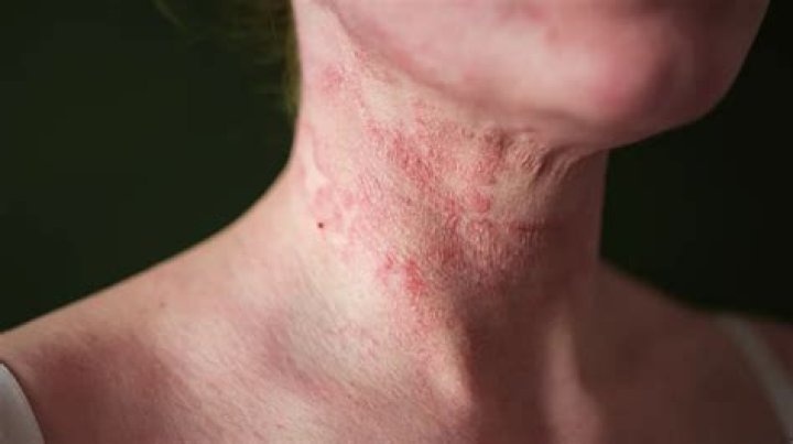 How do I get rid of a dry rash on my neck?