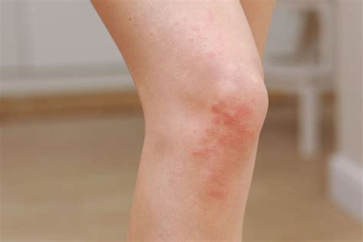 How do you get rid of Neurodermitis?