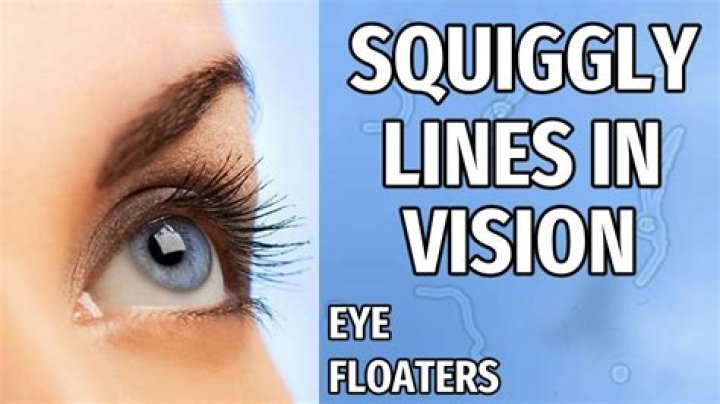 How do you get rid of squiggly lines in your eyes?