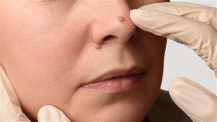 How do you know if you have a wart on your face?