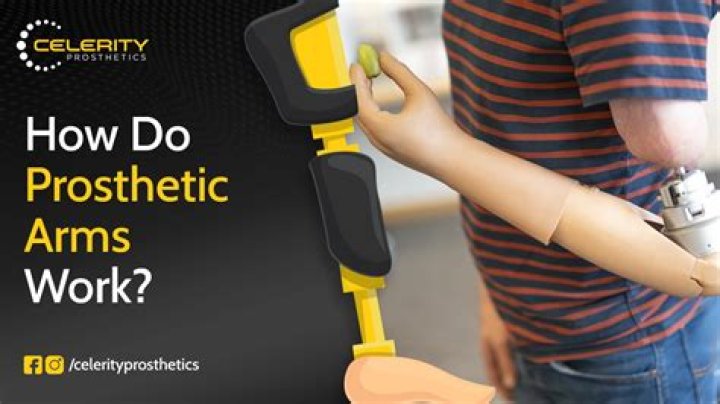 How does a prosthetic hand work?
