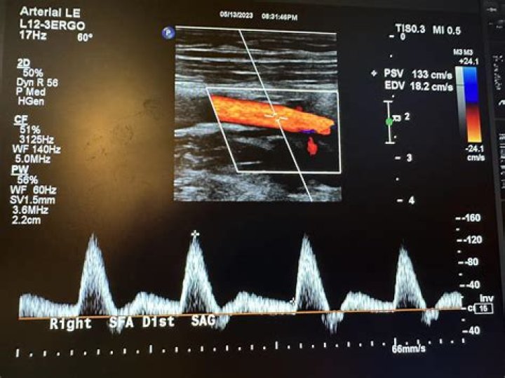 How is an arterial Doppler performed?