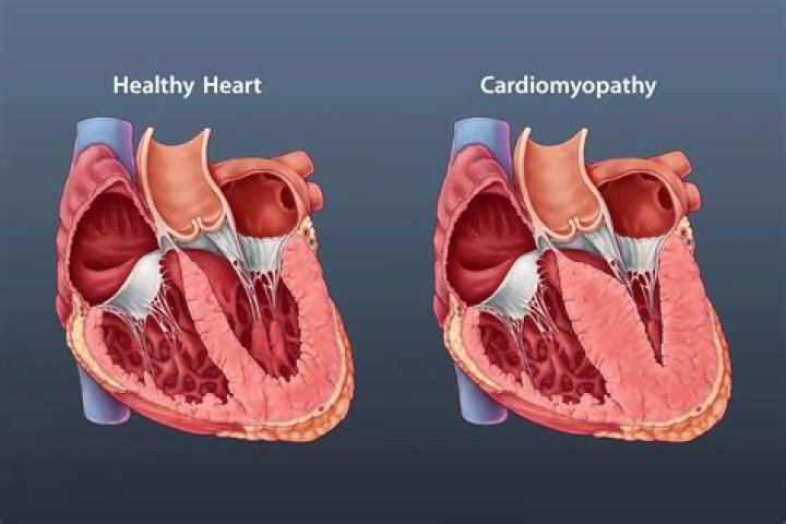How long can you live with postpartum cardiomyopathy?