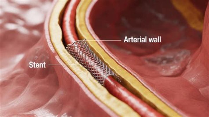 How long do cardiovascular stents last?