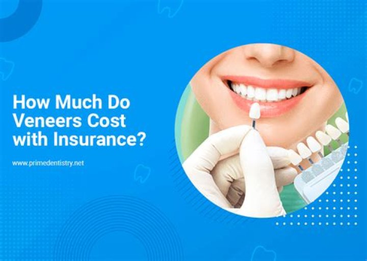 How much do veneers cost UK NHS?