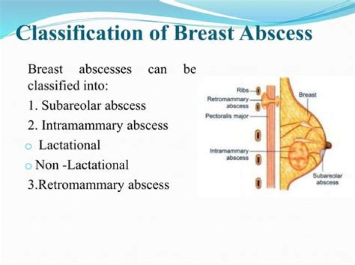 Is breast abscess serious?