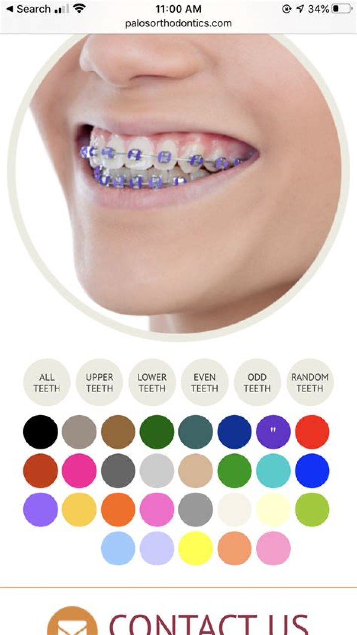 Is Lavender a good braces color?