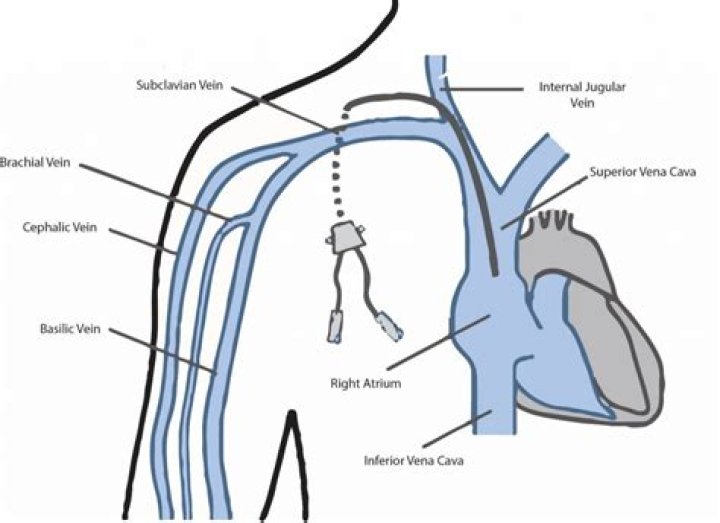 Is PICC line a tunneled catheter?