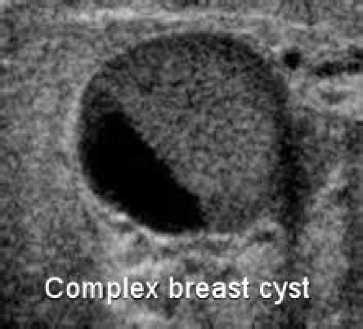 What are the chances of a complex breast cyst being cancerous?