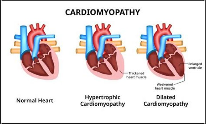 What causes baby cardiomyopathy?
