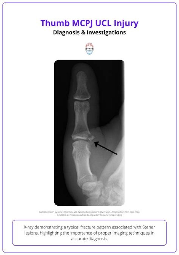 What causes pain in the MCP joint of the thumb?