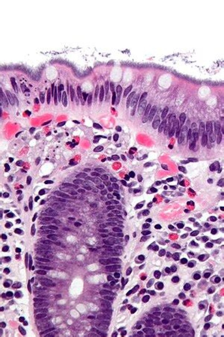 What causes Spirochetosis?