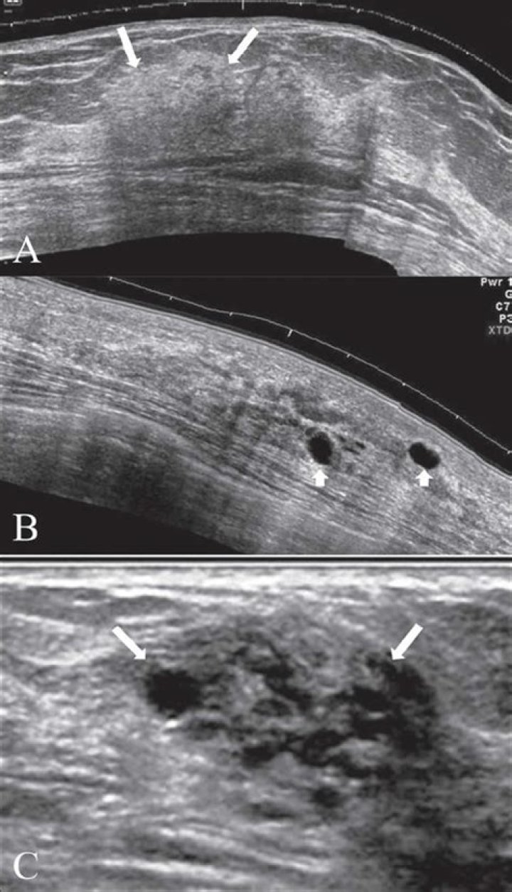 What does a fibrocystic look like?