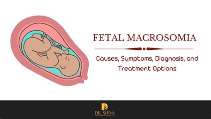 What does macrosomia mean in medical terms?