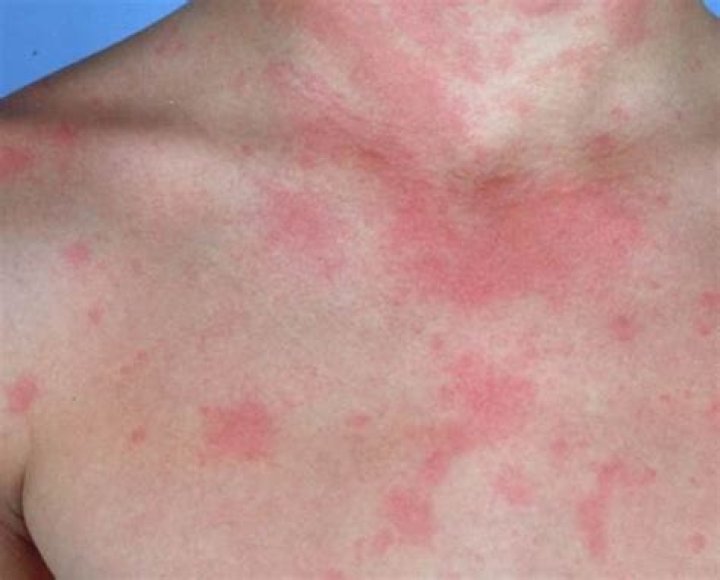 What does physical urticaria look like?