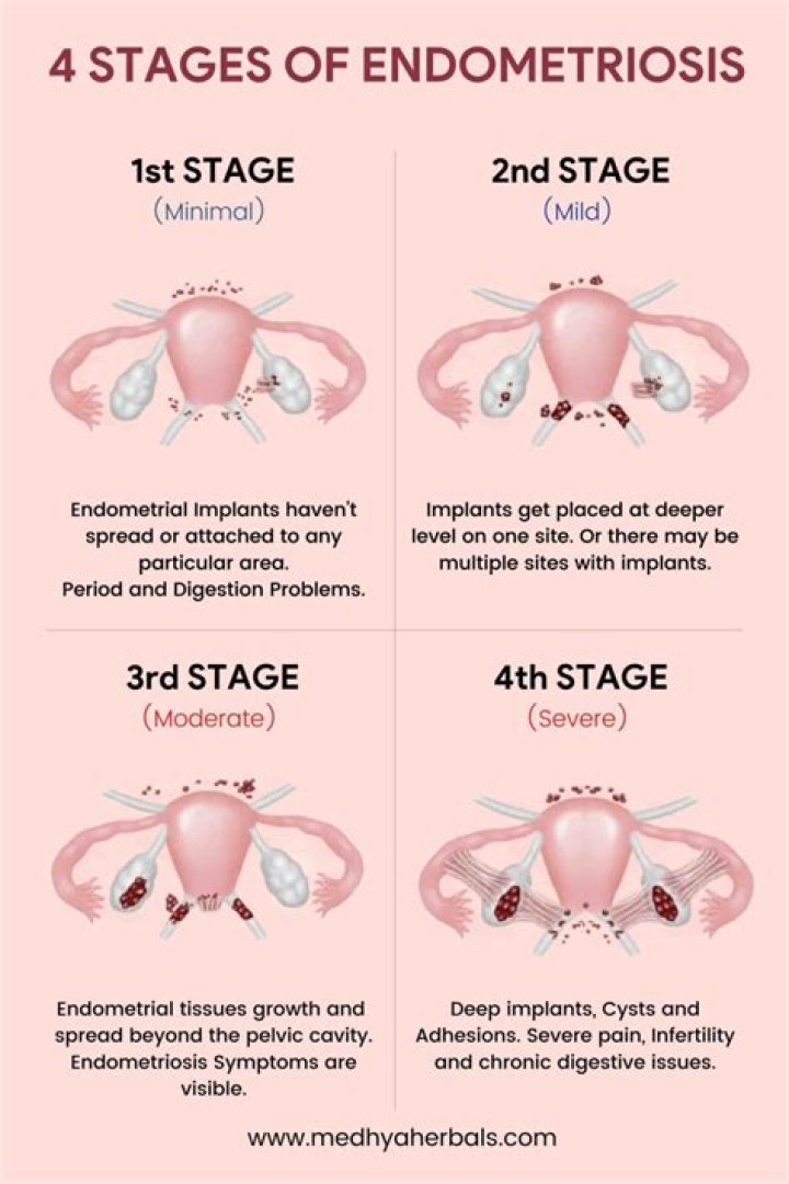 What does Stage 4 endometriosis look like?