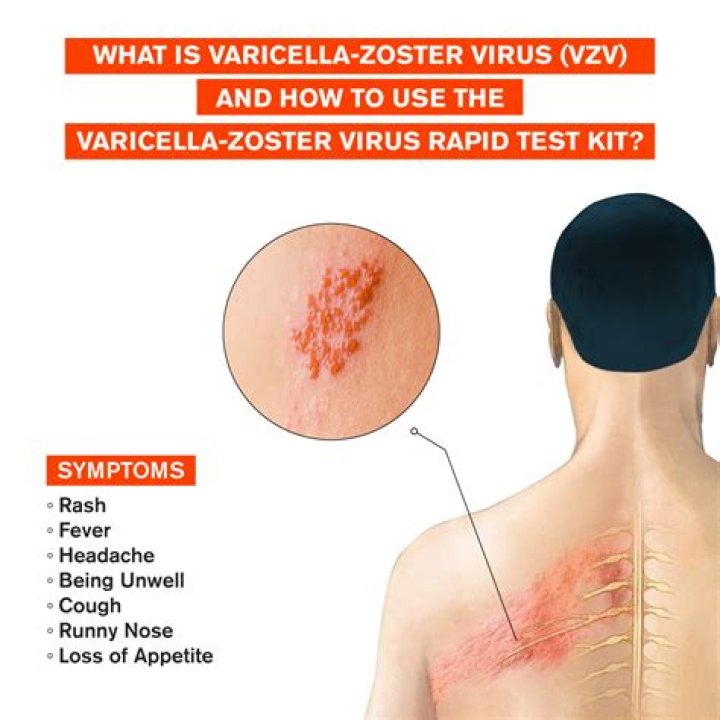 What does varicella zoster look like?