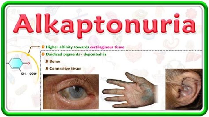 What happens to a person with alkaptonuria?
