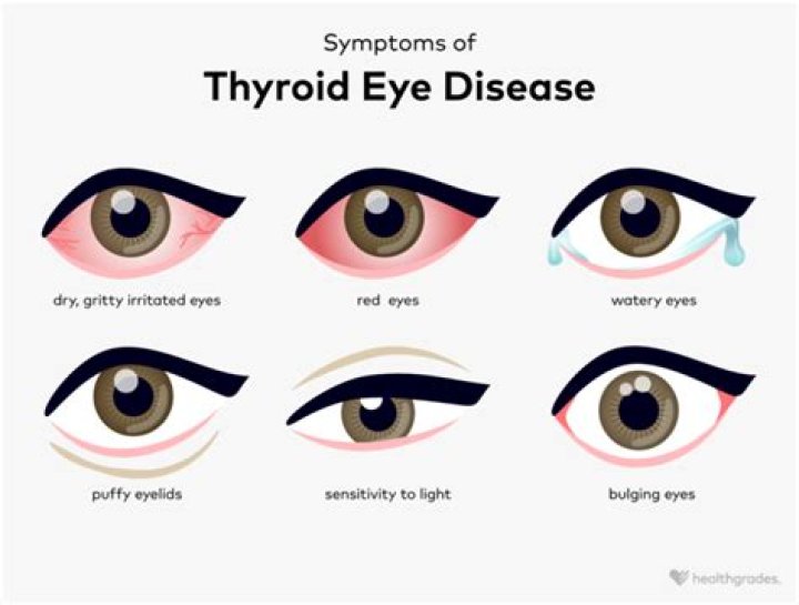 What happens to the eyes in hyperthyroidism?