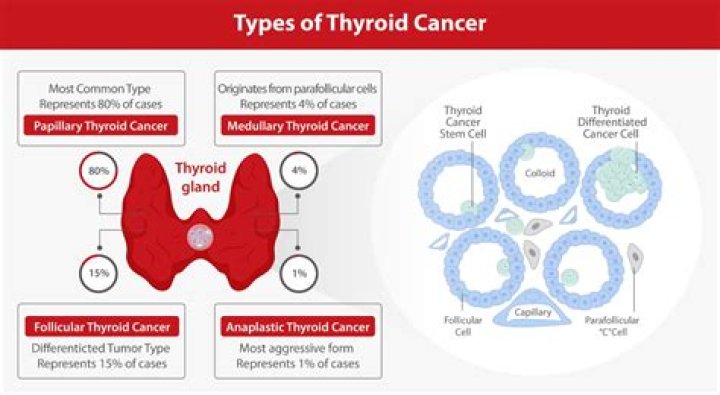 What happens when papillary thyroid cancer spreads?