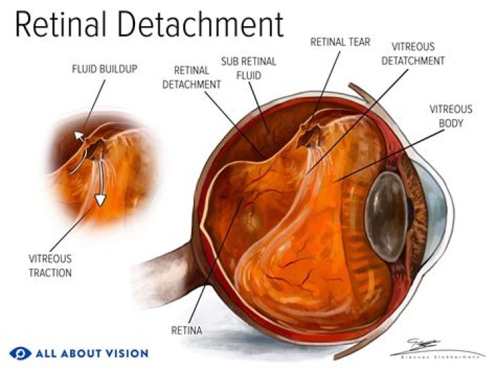 What happens when you detach XYZ?