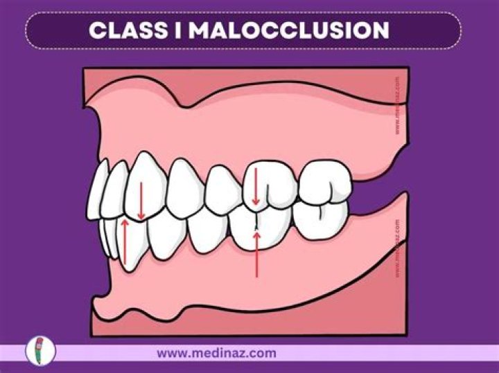 What is a Class 1 molar?