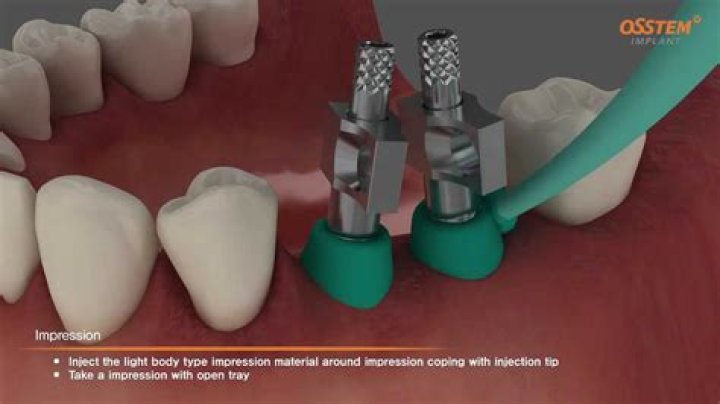 What is a implant coping?