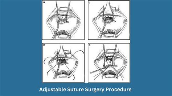 What is adjustable suture technique?