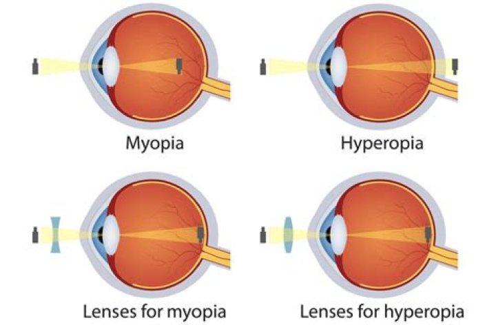 What is high myopia for eyes?
