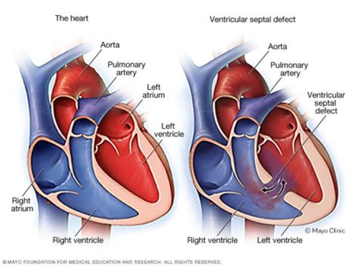 What is meant by VSD?