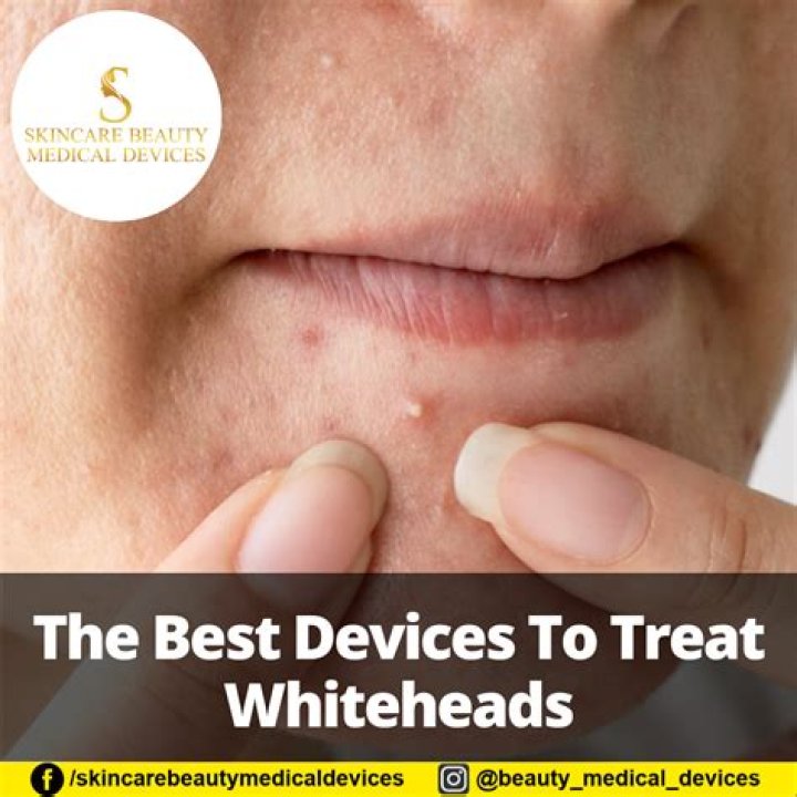 What is the best facial treatment for whiteheads?