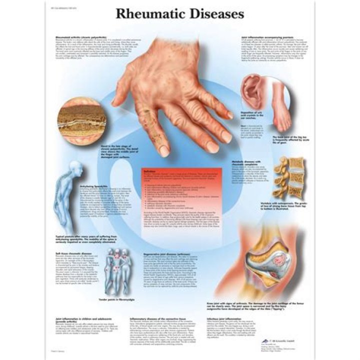 What is the word rheumatic mean?
