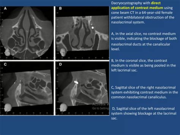 Which method is used for Dacryocystography?