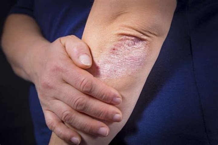 Why are my elbows so red and dry?