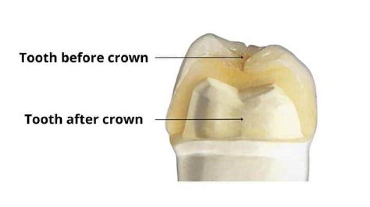 Why did my crown crack?