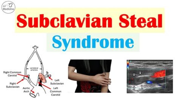 Why is subclavian steal syndrome more common on the left?
